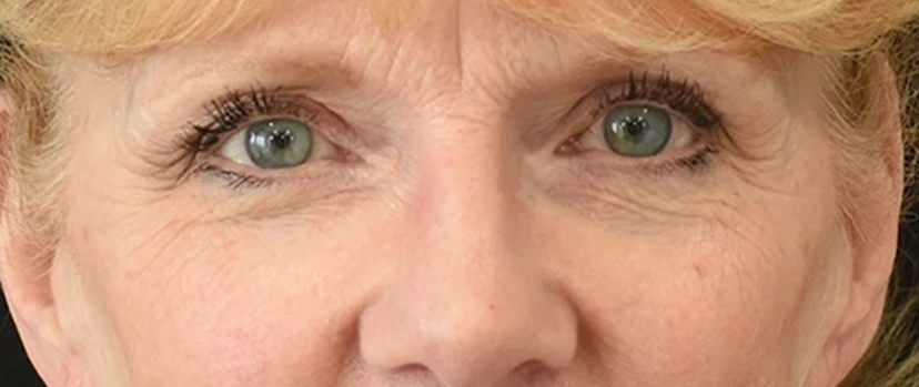 Brow Lift Patient 5 Set 1 Before